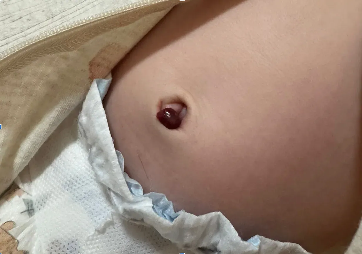 Granuloma umbilical en bebé