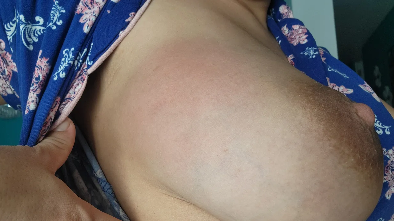 Seno con un área enrojecida, signo común de mastitis.
