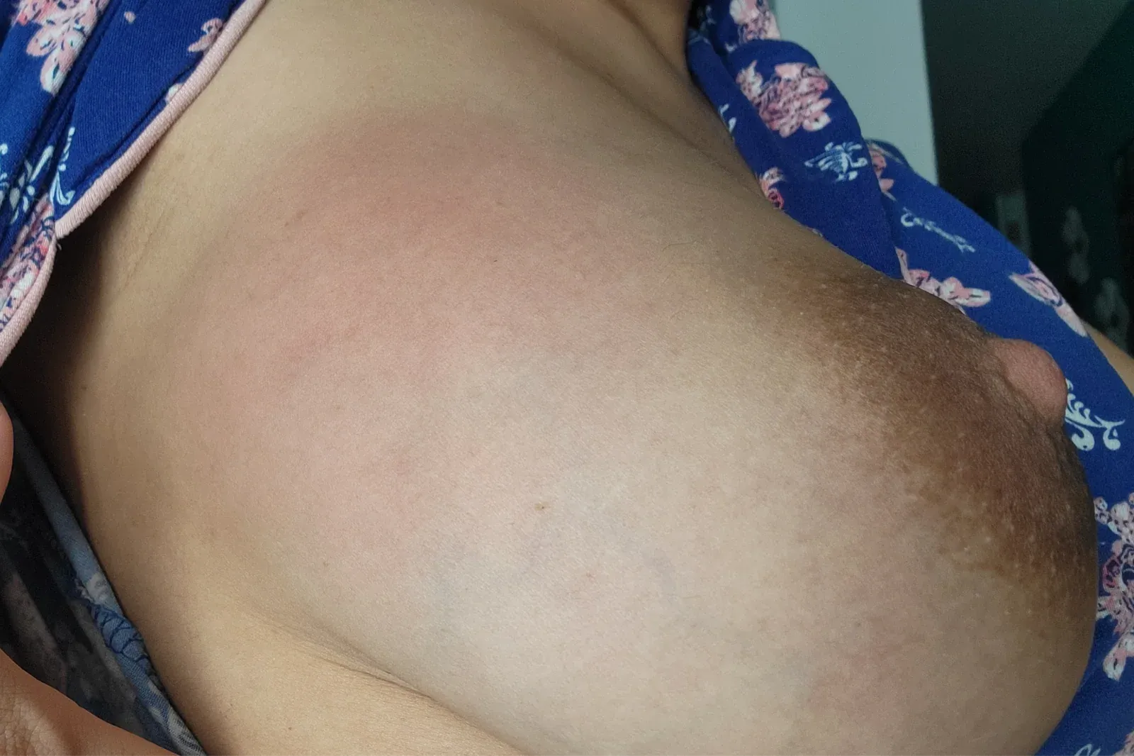 Madre lactante con síntomas de mastitis.